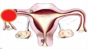 Laparoscopic Management of Chronic Ectopic and Myomectomy in same patient