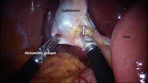 Totally Extraperitioneal Repair Of Hernia