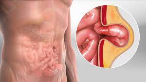 Recurrent Hernia Laparoscopic Repair