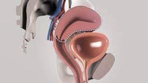 Laparoscopic Surgery for Pedunculated Myoma by Mishra's Knot