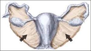 Laparoscopic Removal of Intramural and Broad Ligament Myoma