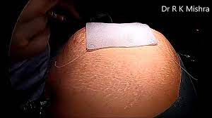 Incisional Hernia IPOM Repair with Dual Mesh