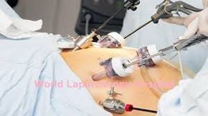 Laparoscopic sterilization with the Falope-ring technique