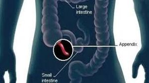 Laparoscopic Appendectomy for Fecalith of Appendix