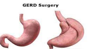 Laparoscopic Fundoplication for GERD