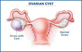 Laparoscopic Ovarian Cystectomy - Aspiration with Transparent Needle