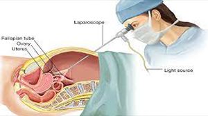 Laparoscopic Ovarian Cystectomy for Large Ovarian Cyst