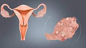 Ovarian cystectomy for Right Ovarian Cyst