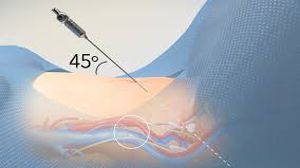 Laparoscopic Repair of Inguinal Hernia Using Intra peritoneal Onlay Mesh & Fibrin Glue
