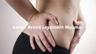 Laparoscopic Myomectomy for Broad Ligament Myoma