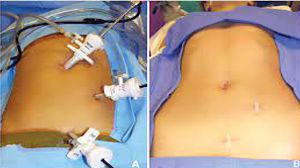 Pediatric Laparoscopic Appendectomy by Two Ports