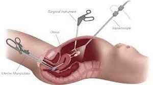 Diagnostic Laparoscopy Ovarian Drilling for PCOD and Tubal Patency Test