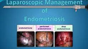 Laparoscopic Management of Bilateral Endometrioma with Pelvic Adhesion