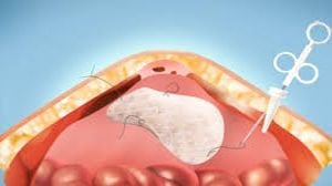 Robotic Hernia Surgery by Dr. R.K. Mishra - External View