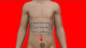 Laparoscopic Repair of Large Suprapubic Hernias