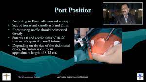 Pediatric Laparoscopy Lecture by Dr R K Mishra