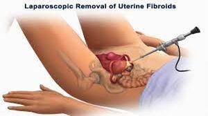 Open myomectomy is better for multiple huge intramural fibroid
