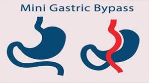Mini Gastric Bypass (MGB) Surgery for Morbid Obesity