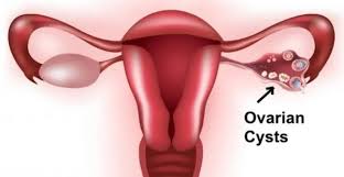 Ovarian cystectomy for Left Ovarian Cyst