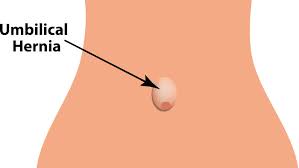 Paraumbilical Hernia Repair by Laparoscopy