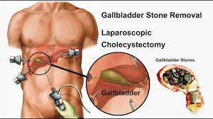 Video of Laparoscopic Gallbladder Stone Surgery