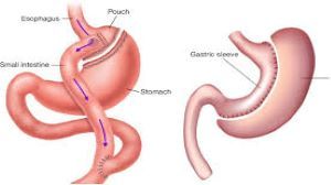 Conversion from sleeve gastrectomy to Roux-en-Y gastric bypass