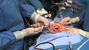 Surgery for Gallbladder Stone