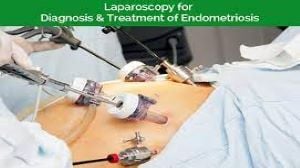 Laparoscopic Surgery for Endometrial Cyst