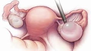 Left Sided Ovarian Cyst Laparoscopic Approach