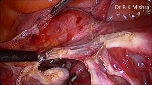 Torted Ovarian Dermoid Cyst in Pregnant Patient