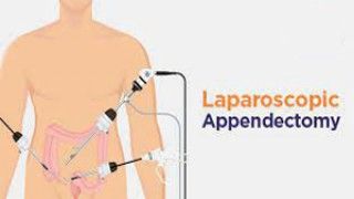 Laparoscopic Salpingo oophorectomy for Huge Ovarian Cyst by Dr. R.K. Mishra