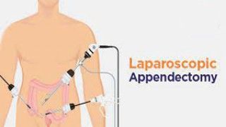 Laproscopic Appendicectomy Lecture by Dr R K Mishra