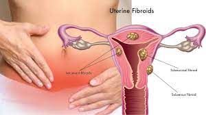 Laparoscopic Myomectomy for Intramural Myoma