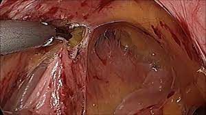 Laparoscopic Repair of Umbilical Hernia