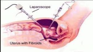 Total Laparoscopic Hysterectomy by Myoma Screw Without Uterine Manipulator