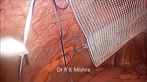 Totally Extraperitoneal Repair of Hernia Lecture by Dr R K Mishra