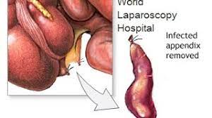 Laparoscopic Appendectomy by Bipolar