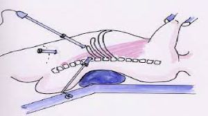Mishra's Knot - Ideal for Laparoscopic Cholecystectomy