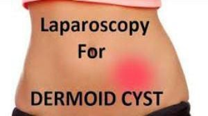 Ovarian Cystectomy by Laparoscopy for Dermoid Cyst