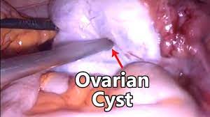 Laparoscopic Ovarian Cystectomy