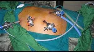 हिस्ट्रेक्टोमी -  दूरबीन द्वारा गर्वासेय के ऑपरेशन की प्रकिया  हिस्ट्रेक्टोमी सर्जरी की प्रक्रिया