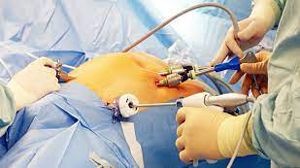 Three-Port Total Laparoscopic Hysterectomy (TLH) with Infrared Ureteric Catheter