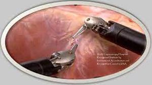 Laparoscopic cardiomyotomy and Dor fundoplication