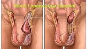 Laparoscopic Heller's Myotomy with Appendectomy