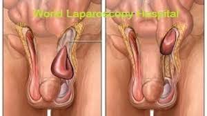 Laparoscopic inguinal hernia repair "IPOM" with Dual-Mesh