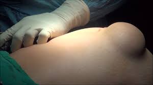 Laparoscopic Incisional Hernia Repair after previous Mc Burney's incision