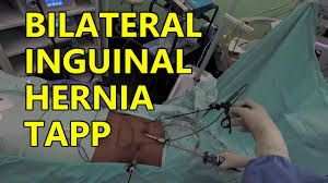 Bilateral TAPP Inguinal Hernia Surgery