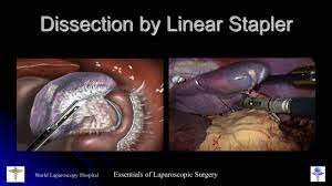 Laparoscopic Splenectomy Lecture by Dr R K Mishra