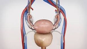 Total Laparoscopic Hysterectomy and Bilateral Salpingo-Oophorectomy