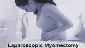 Laparoscopic Myomectomy for Large Uterine Fibroid